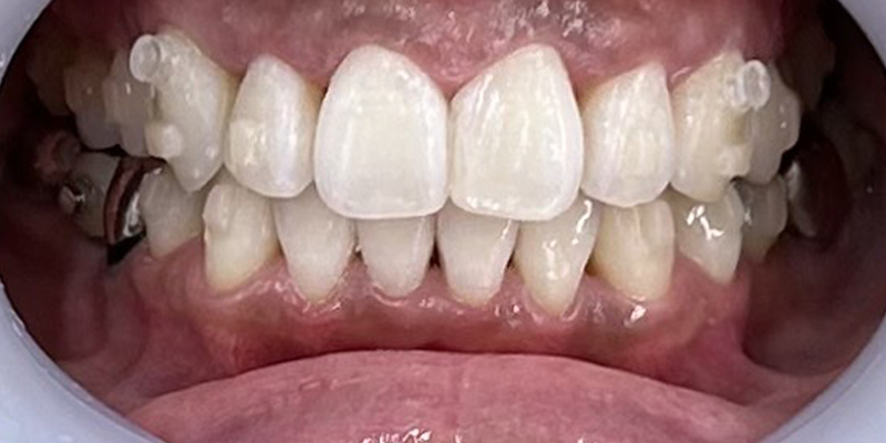 症例_10アフター画像