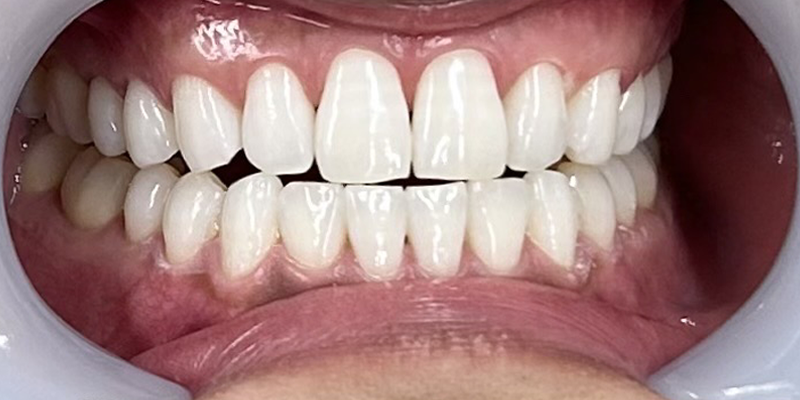 症例_7アフター画像