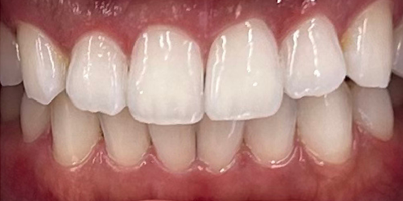 症例_8アフター画像