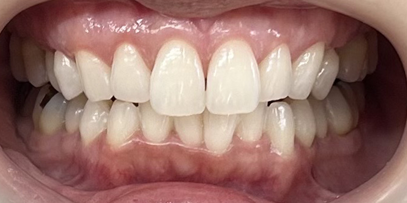 症例_9アフター画像