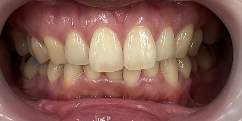 症例_9ビフォー画像